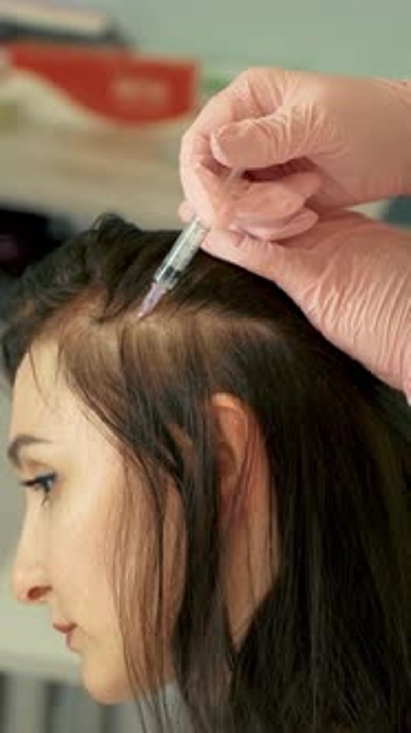 Hair Injection Beautician Makes Injections Into Scalp for Hair Growth ...