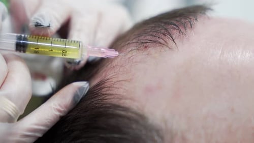 Macro shot of Hair mesotherapy procedure in the modern cosmetology clinic, plasma injectiions.