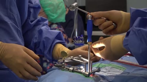 Cages intercorporelles pour Spine Fusion