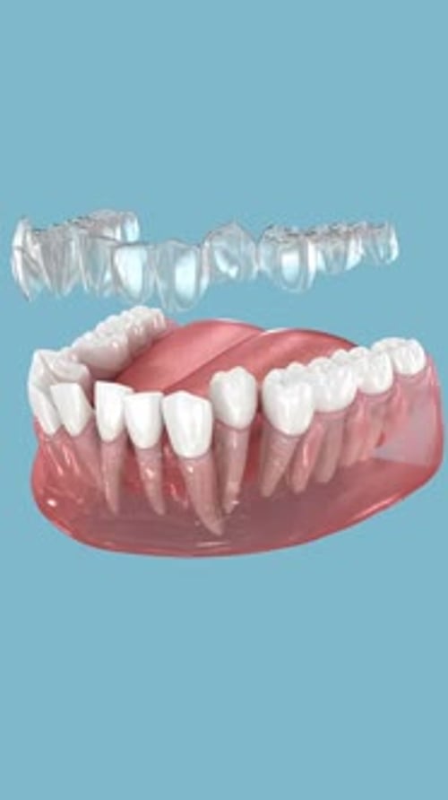 Clear Dental Aligner Animation for Orthodontic Treatment