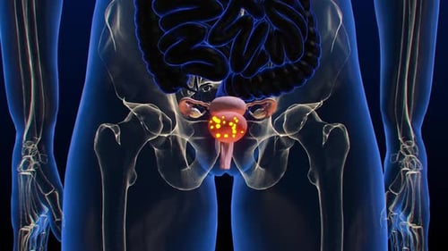 3D Medical Animation of Human Uterus Infection and Disease