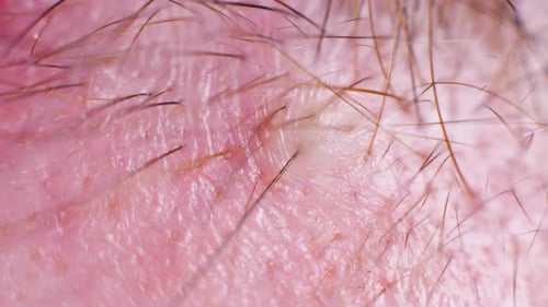 4K Super macro shot of hair removal with tweezers, on a caucasian person, at an extreme close up, in
