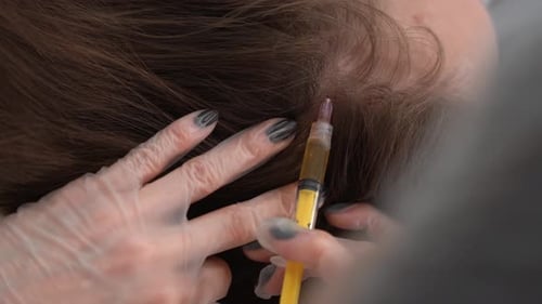 Medical Professional Injecting Scalp for Hair Restoration
