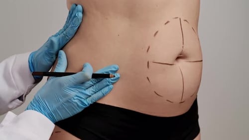 Cosmetic Surgeon Marking Patient's Abdomen for Procedure
