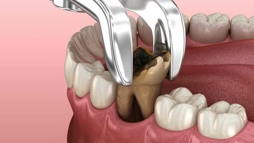 3D Animated Tooth Decay and Extraction Process