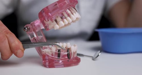 Dental Implant Model with Prosthetic Tooth Installation