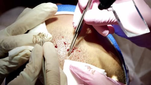 Close up of individually harvested hair follicles from patient's beard during FUE transplantation pr
