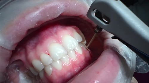 Dental Extreme Close Up Macro Video Cleaning Process in Patient's Mouth Clean Teeth with Water Jet