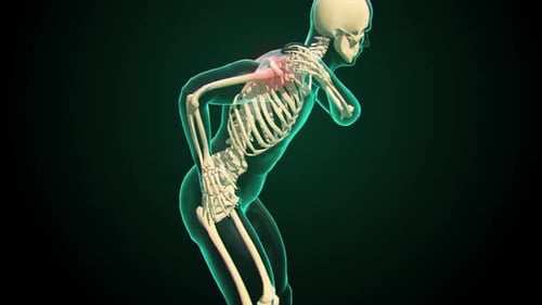 3D Human Skeleton with Shoulder Pain Medical Animation