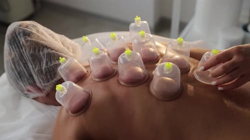 Woman Receives Cupping Therapy Treatment on Her Back