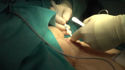 Surgeons Perform Medical Procedure in Operating Room