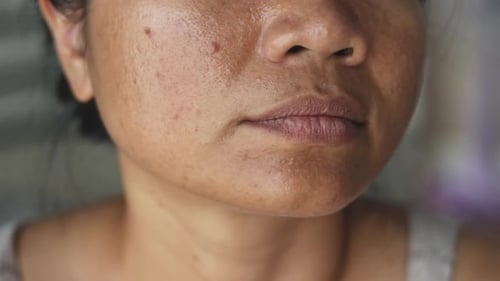 Acne skin close-up – woman examining facial imperfections in mirror