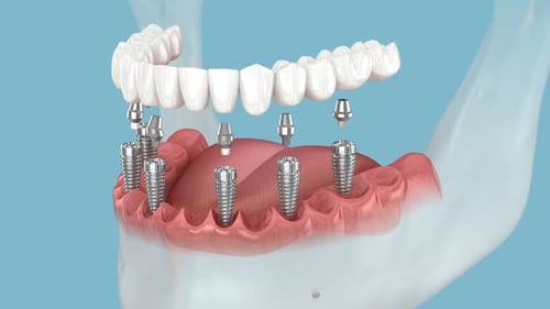 Dental Implant Surgery in Mandibular Jaw 3D Animation