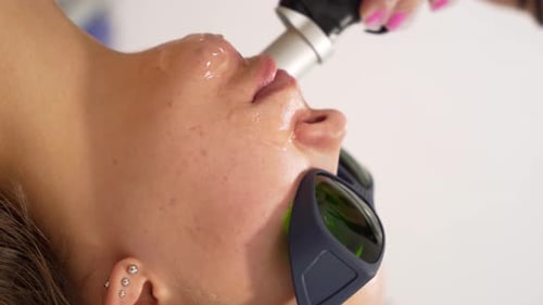 Close up of woman face modern alexandrite laser hair removal procedure. Concept of women beauty