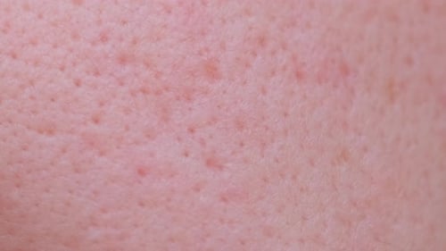 Closeup of Skin with Large Pores and Blemishes Girl with Problem Skin