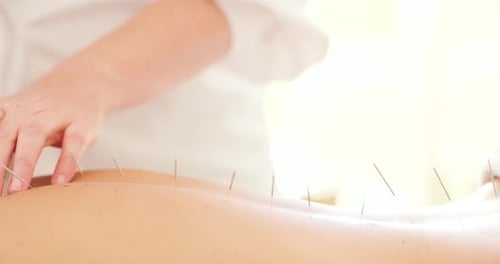 Primer plano de una masajista con agujas de acupuntura que trata a una paciente desconocida en una clínica