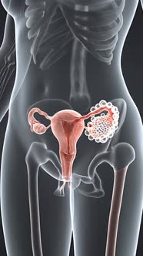 Pcos - Polycystic Ovaries Frontal View 3D Medical Animation| Manestream Den