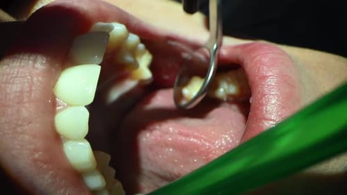 Dental Care Extreme Close Up Macro Video Dentist Treat Patient Teeth Orthodontist Works with