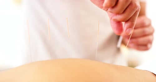 Relajación, terapia de acupuntura y medicina tradicional, las manos del terapeuta con una aguja en la piel