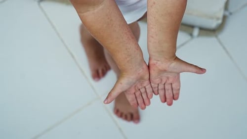 Entérovirus (jambe, bras, bouche)