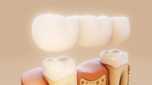 Conceptual 3D animation of a dental bridge