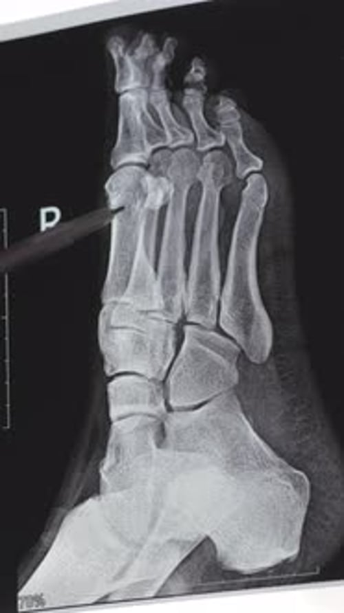 Vertikales Röntgenbild eines Trauma-Fingers
