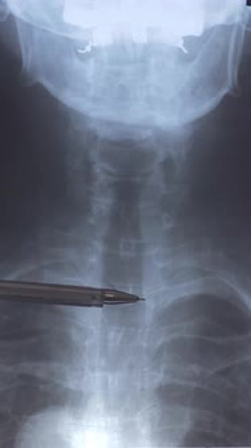 X-Ray of Spine with Pen Pointing to Spot