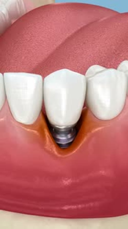 Peri-implantitis and gingiva recession. Dental 3D animation