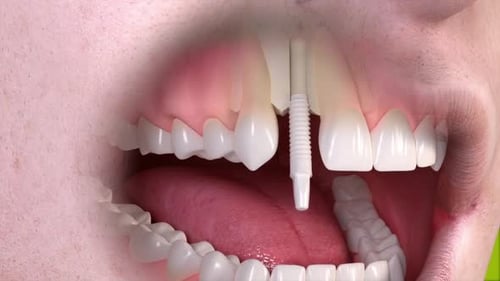 3D Animation of Dental Implant Placement and Tooth Restoration