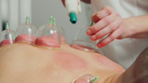 Therapeutic Cupping Treatment on Person's Back
