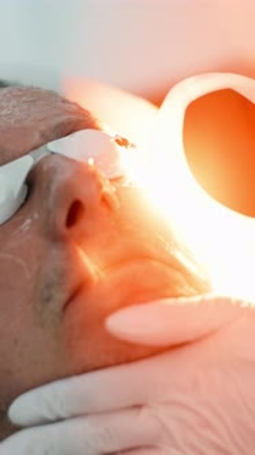Man Receiving Laser Treatment on Face, Close Up