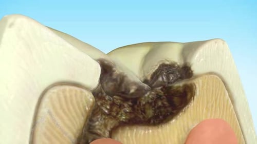 Molar tooth damaged by caries. Medically accurate tooth 3D animation