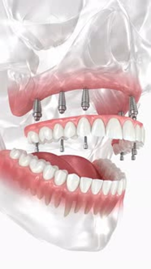 All-on-4 Dental Implant Procedure 3D Medical Animation