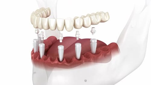 Prótese dentária baseada em 6 implantes cerâmicos