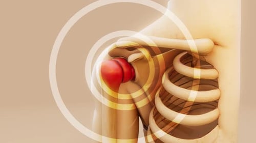 Human Shoulder Joint Pain and Inflammation Medical Animation