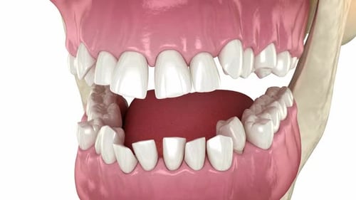 3D Animation of Human Jaw with Misaligned Teeth