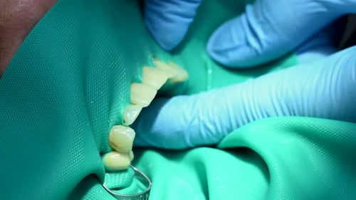 Medizinischer Zahnarzt Nahaufnahme Makro-Video Zahnarzt behandelt Patientenzähne Karies Karies Kieferorthopäde arbeitet mit