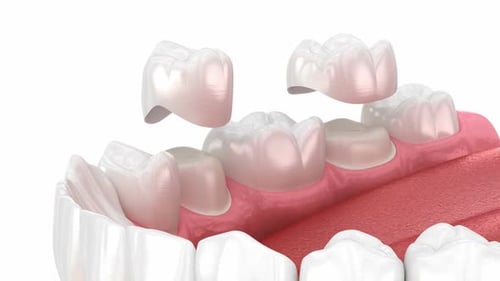 Dental crowns placement over teeth. Dental 3D animation