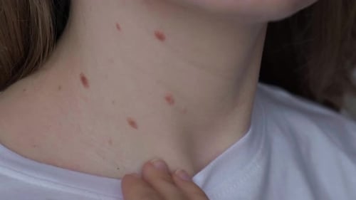 Unrecognizable Woman Showing Her Birthmarks on Skin Close Up Detail of the Bare Skin Sun Exposure