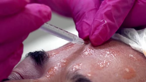 A woman getting Botox injections on her face - close up detail