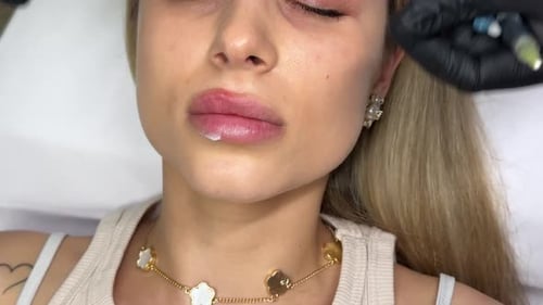 Lip Filler Injection for Cosmetic Enhancement