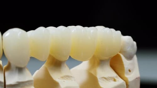 Three Unit Dental Bridge with Ceramic Crowns on Tooth Model