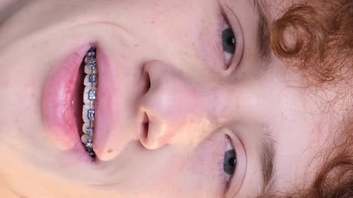 Smiling Face With Braces, Close Up Shot