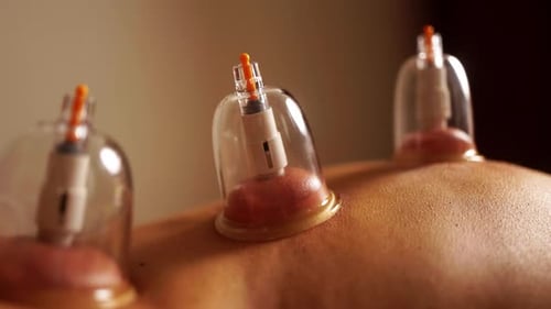 Chinese cupping therapy at spa. Vacuum suction treatment for pain relief