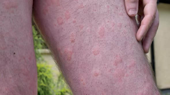 Skin Rash on Man's Leg Close Up, Medical Stock Footage ft. skin & hives ...