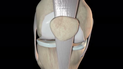 Animation zur zerkleinerten Patellafraktur mit beschädigtem menschlichem Knieknochen