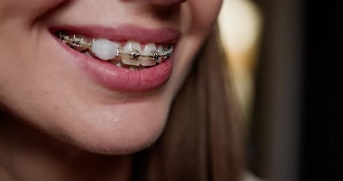 Primer plano de una mujer joven que muestra aparatos dentales que enfatizan el tratamiento de ortodoncia