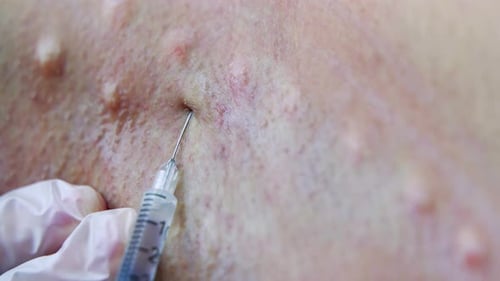 Close-up of Injection on Skin
