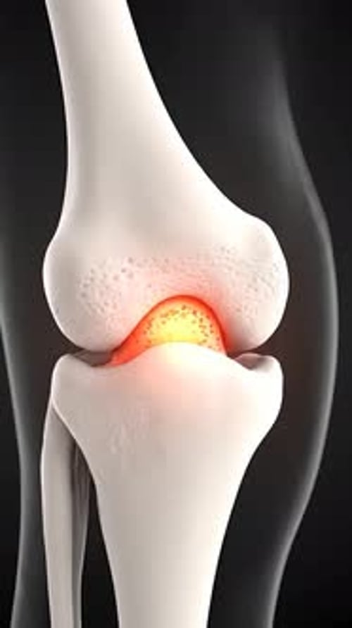Animated 3D Human Knee Joint Inflammation