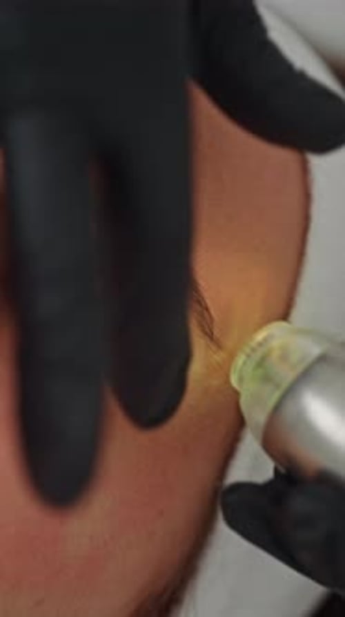 Laser Treatment for Facial Skin Rejuvenation